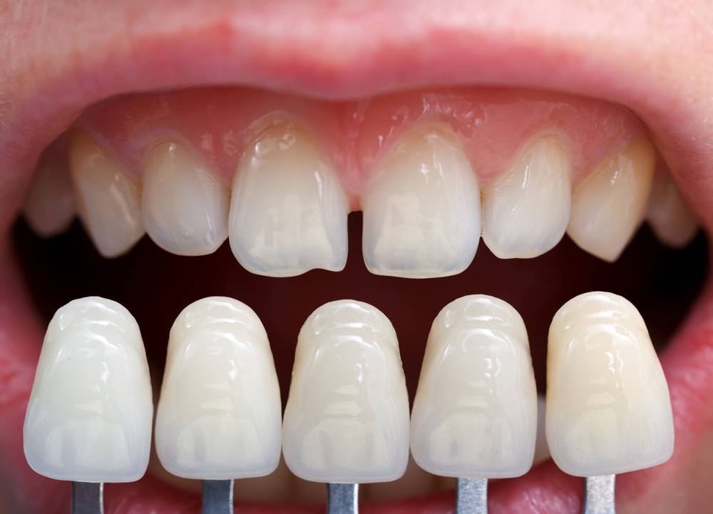 carillas-o-coronas-renovando-sonrisas-para-una-buena-estetica-dental- imagen de artículo